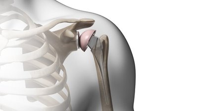 Schulterarthrose, Schulterprothese