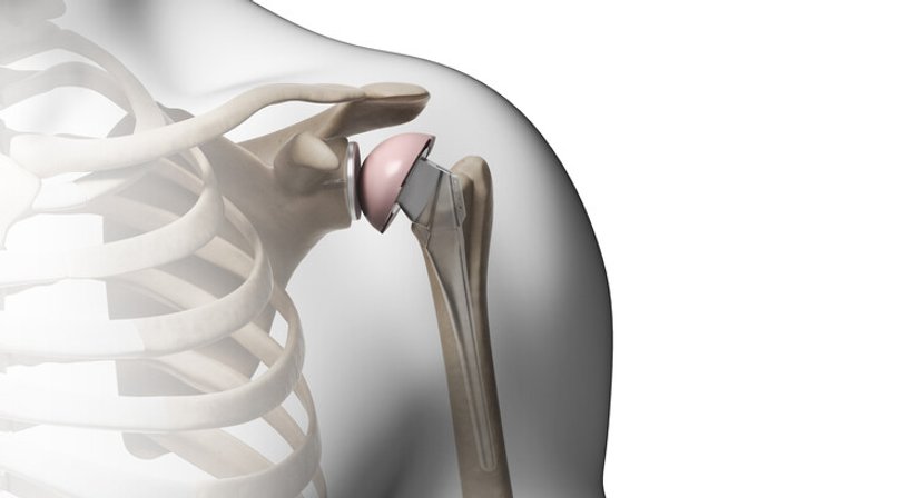 Schulterarthrose, Schulterprothese - Dr. Omar El-Shohoumi - Orthopäde Stockerau 2000