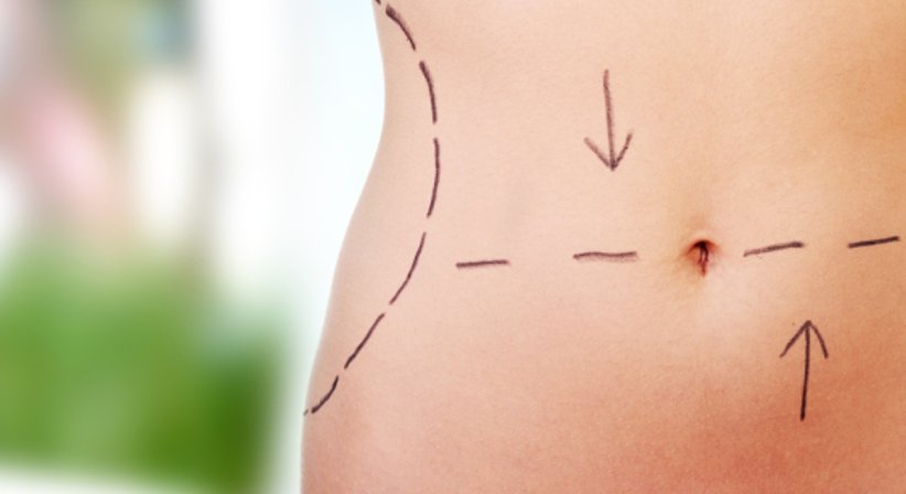 Body Countouring - Univ.-Doz. Dr. Franz Maria Haas - Plastischer Chirurg Graz 8047