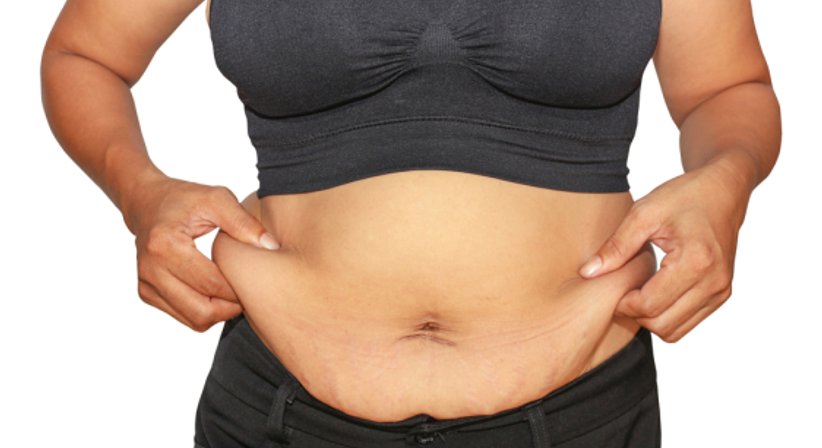 Fettabsaugung - Univ.-Doz. Dr. Franz Maria Haas - Plastischer Chirurg Graz 8047