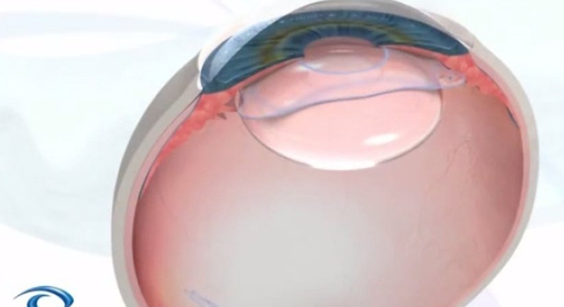 Implantation der  Artisan, Artiflex und Visian ICL Intraokularlinsen - Dr.med.Dr.sci. Jurij Kocmut - Augenarzt Salzburg 5020