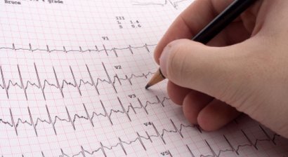 Herzrhythmusstörungen