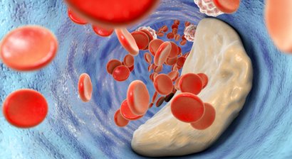Koronare Herzerkrankung