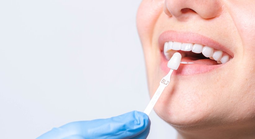 Veneers / Lumineers - Dr. Sherwin Moayedifar - Zahnarzt Wien 1140
