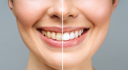 Bleaching (Zahnaufhellung)