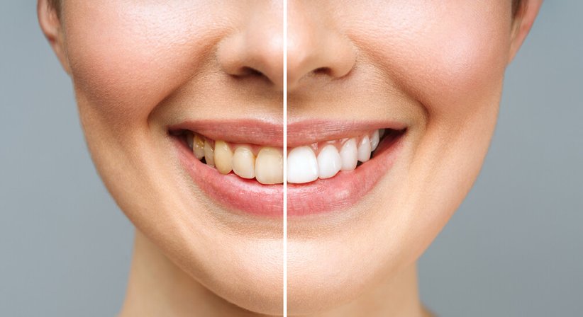 Bleaching (Zahnaufhellung) - Dr. Sherwin Moayedifar - Zahnarzt Wien 1140