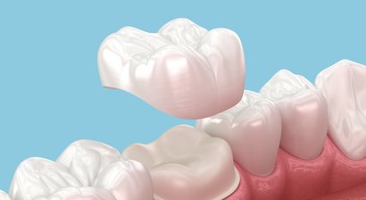 Zahnkronen und Zahnbrücken