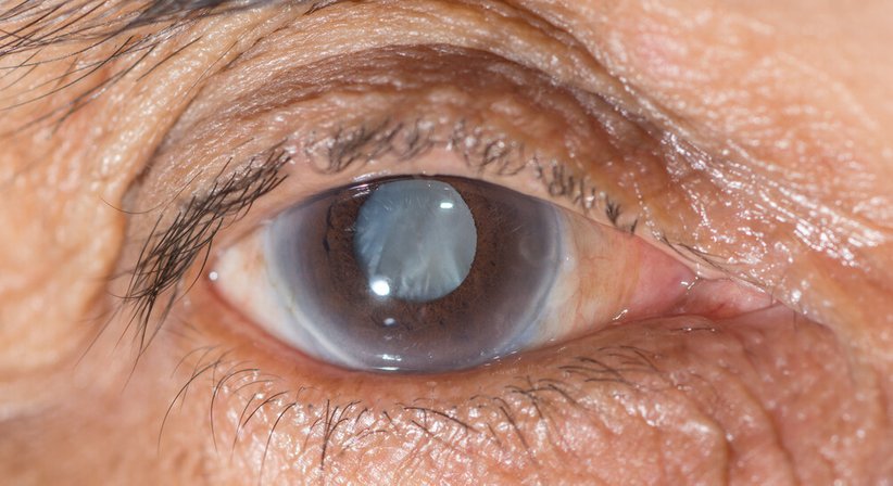 Grauer Star (Katarakt) - Dr. Andreas Grechenig - Augenarzt Wien 1230