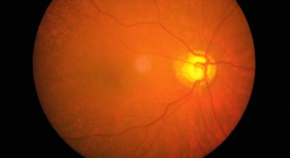 Diabetische Retinopathie