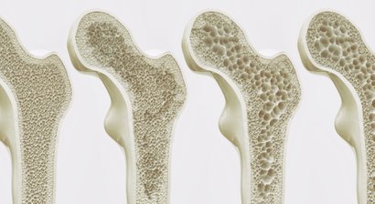 Osteoporose (Knochenschwund)