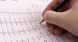 EKG -