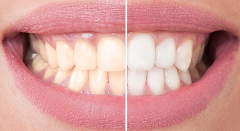 Bleaching - Dr. med. dent. Karin Schweiger (ehem. Jäger) - Zahnärztin Perchtoldsdorf 2380