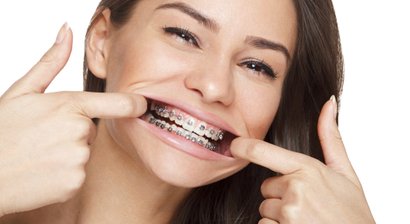 Festsitzende Zahnspangen (Brackets)