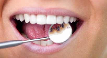 Innenliegende Zahnspange (Lingualtechnik)