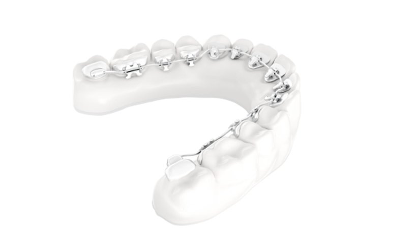 Innenliegende Zahnspange (Lingualtechnik) - Dr. med. dent. Karin Schweiger (ehem. Jäger) - Zahnärztin Perchtoldsdorf 2380