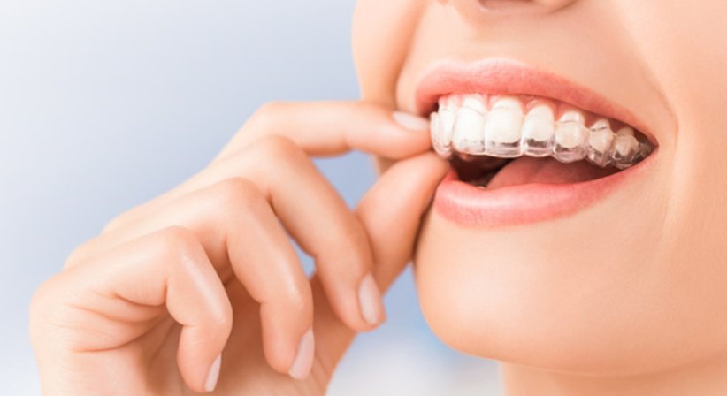 Schienentherapie mit unsichtbaren Alignen - Dr. med. dent. Karin Schweiger (ehem. Jäger) - Zahnärztin Perchtoldsdorf 2380