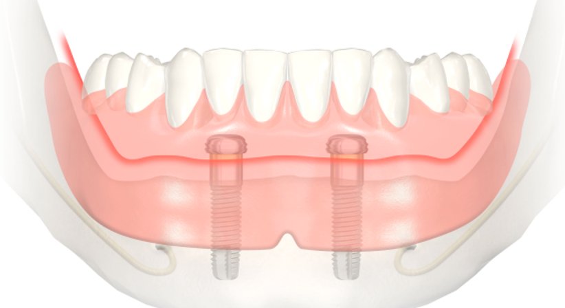 Implantate - Dr. med. dent. Ursula Hersch - Zahnärztin Wien 1030