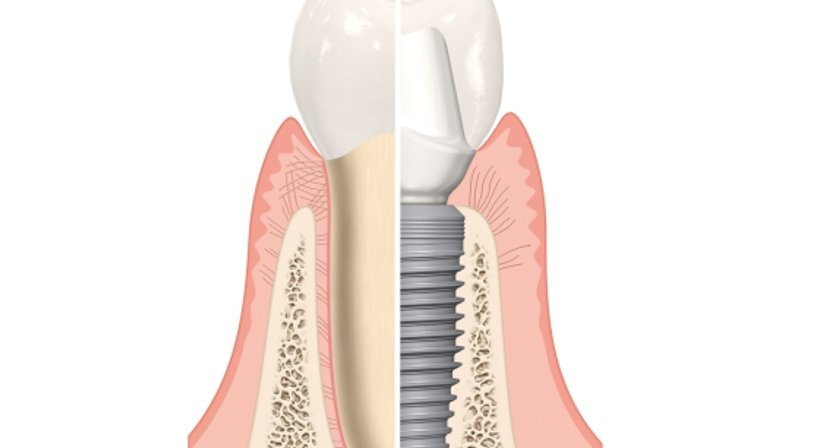 Implantate - Dr. med. dent. Ursula Hersch - Zahnärztin Wien 1030