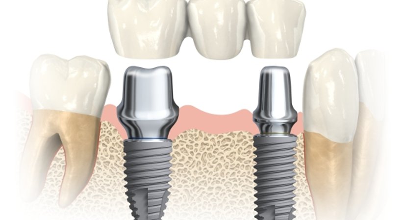 Implantate - Dr. med. dent. Ursula Hersch - Zahnärztin Wien 1030