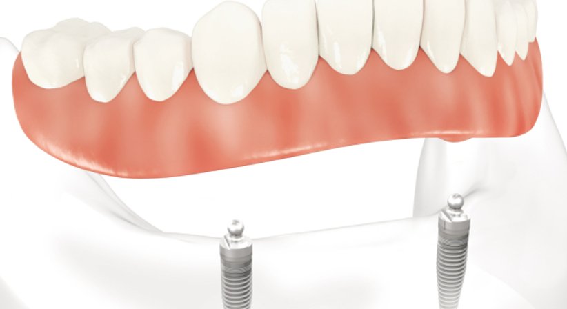 Implantate - Dr. med. dent. Ursula Hersch - Zahnärztin Wien 1030