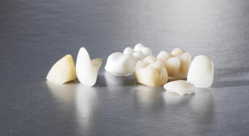 Restaurative Zahnheilkunde  (Veneers, Inlays, Kronen) - Dr. med. dent. Ursula Hersch - Zahnärztin Wien 1030