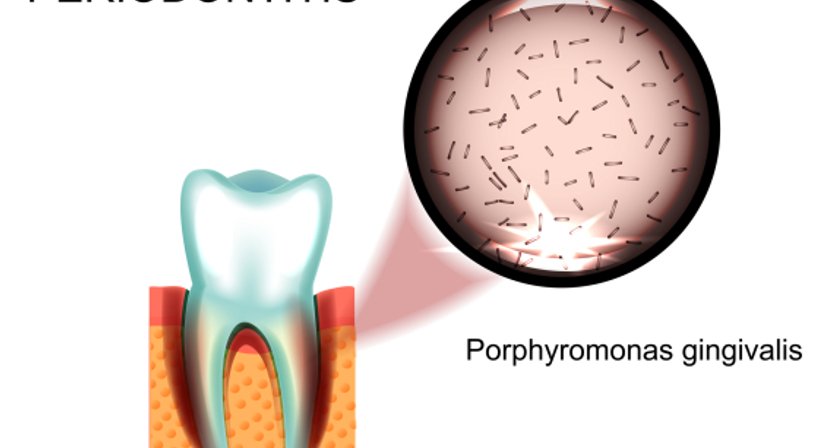 Parodontaltherapie / Paradontitisbehandlung - Dr. Karl Schwaninger - Zahnarzt Wien 1090