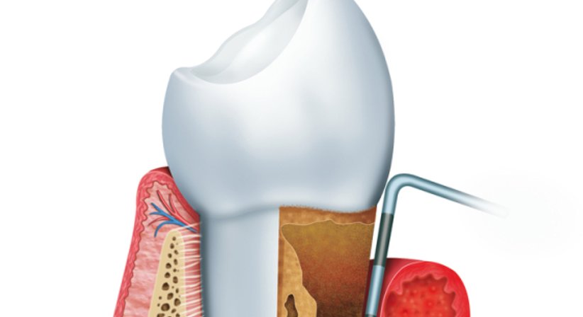 Parodontaltherapie / Paradontitisbehandlung - Dr. Karl Schwaninger - Zahnarzt Wien 1090