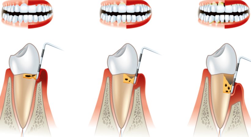 Parodontaltherapie / Paradontitisbehandlung - Dr. Karl Schwaninger - Zahnarzt Wien 1090