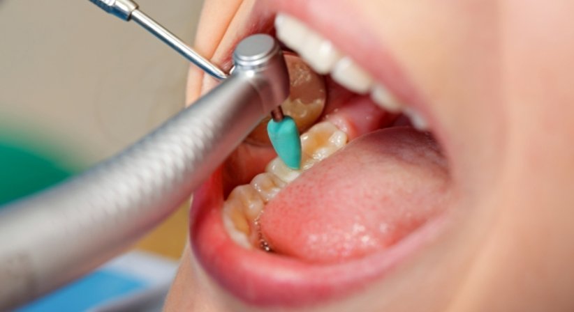 Professionelle Mundhygiene inkl. Entfernung von Zahnstein - Dr. Karl Schwaninger - Zahnarzt Wien 1090