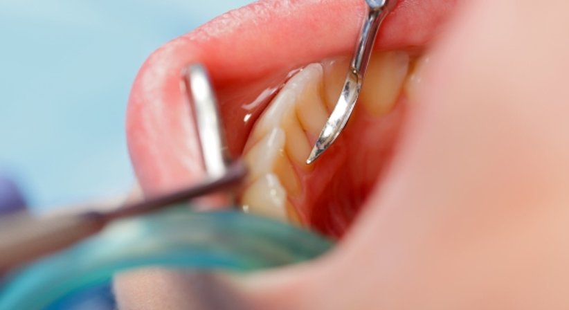 Professionelle Mundhygiene inkl. Entfernung von Zahnstein - Dr. Karl Schwaninger - Zahnarzt Wien 1090