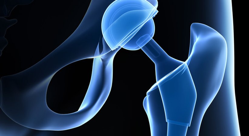 Hüftprothese - Dr. Wolfgang Freilinger, LL.M. - Orthopäde Wien 1140