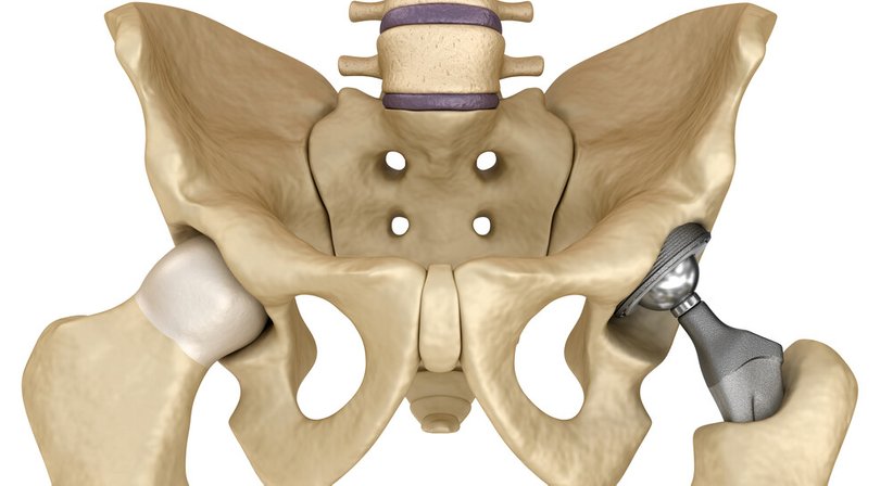Hüft- und Knieendoprothetik (Künstliches Hüft- und Kniegelenk) - Priv.-Doz. Dr. Nikolaus Lang, MSc - Orthopäde Wien 1040