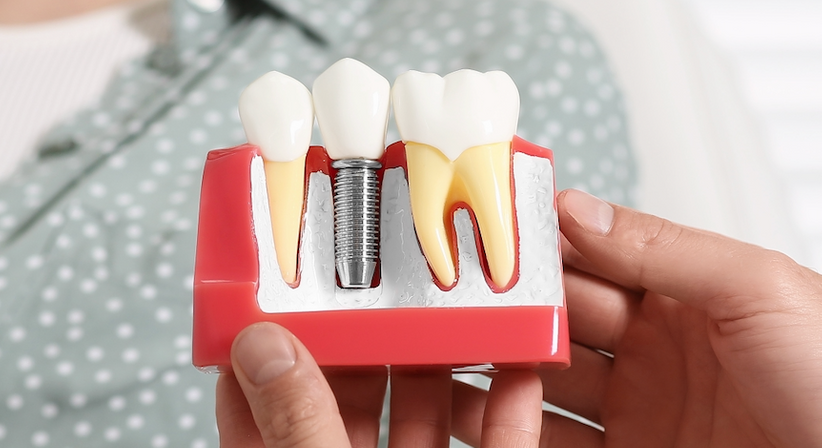 Zahnimplantate - Lic. Sophie Jakolitsch, M.Sc., M.Sc. - Zahnärztin Zell am Moos 4893