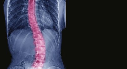 Skoliose (Fehlbildung der Wirbelsäule) / Lumbalskoliose