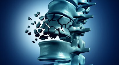 Wirbelsäulentuberkulose