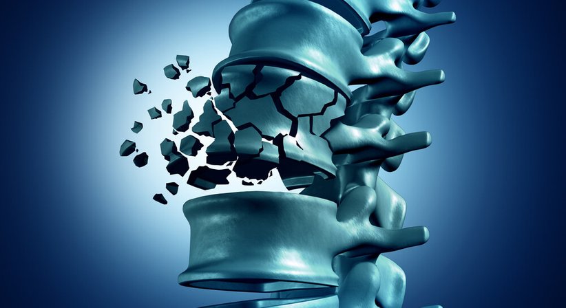 Wirbelsäulentuberkulose - OA Dr. Ronald Josef Sabitzer - Neurochirurg Wien 1060