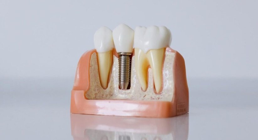 Implantologie bei Dr. med. dent. Yi Kittl