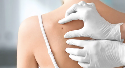 Kryotherapie (Vereisung)