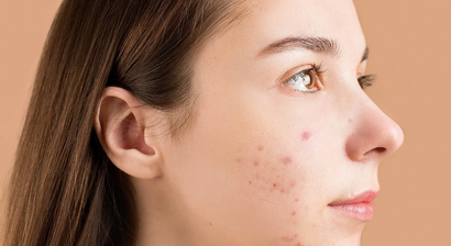 Akne vulgaris, Akne inversa