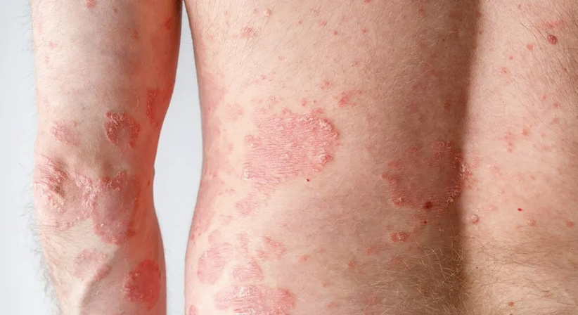 Psoriasis (Schuppenflechte) - Dr. Sophie Hammerer - Hautärztin Wien 1100