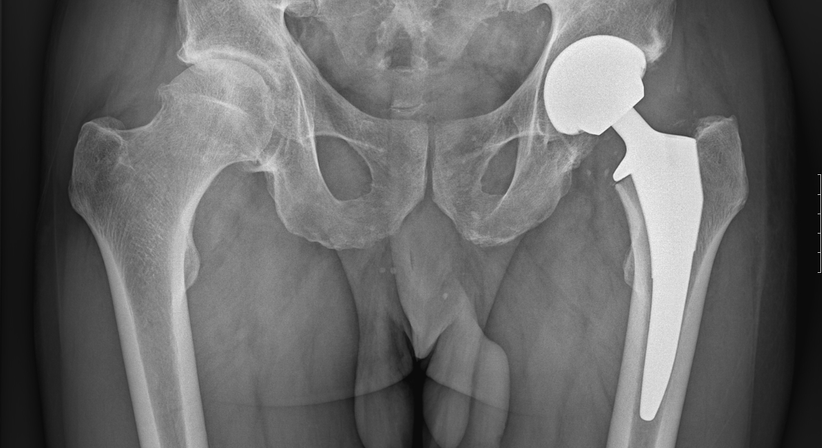 Hüfte - OA Dr. med. univ. Markus Wipperich - Orthopäde Wien 1130