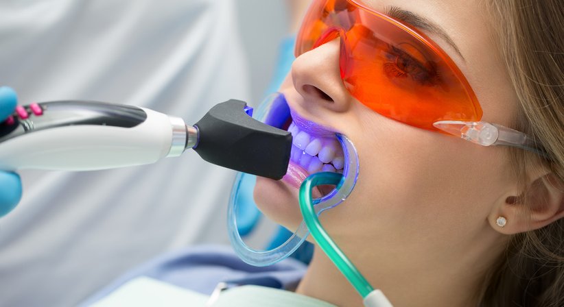 Bleaching - Dr. med. univ. et med. dent. Walther Thaler - Zahnarzt Linz 4020