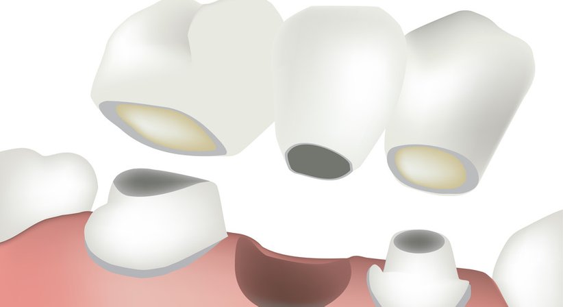 Kronen / Brücken - Dr. med. univ. et med. dent. Walther Thaler - Zahnarzt Linz 4020