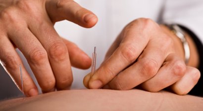 Akupunktur