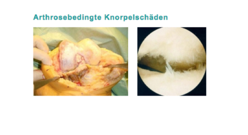 Arthrose - Dr. Hermann Leidolf - Unfallchirurg Innsbruck 6020