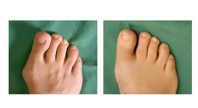 Minimal-invasive Fußchirurgie / Hallux valgus - Dr. Hermann Leidolf - Unfallchirurg Innsbruck 6020