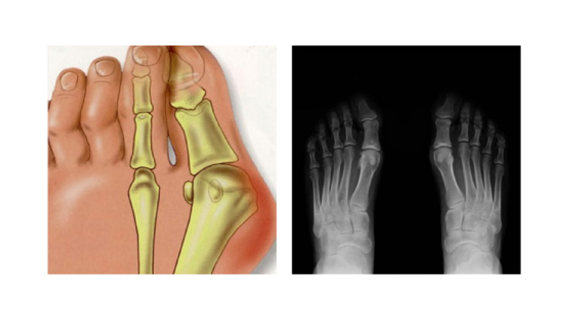 Minimal-invasive Fußchirurgie / Hallux valgus - Dr. Hermann Leidolf - Unfallchirurg Innsbruck 6020