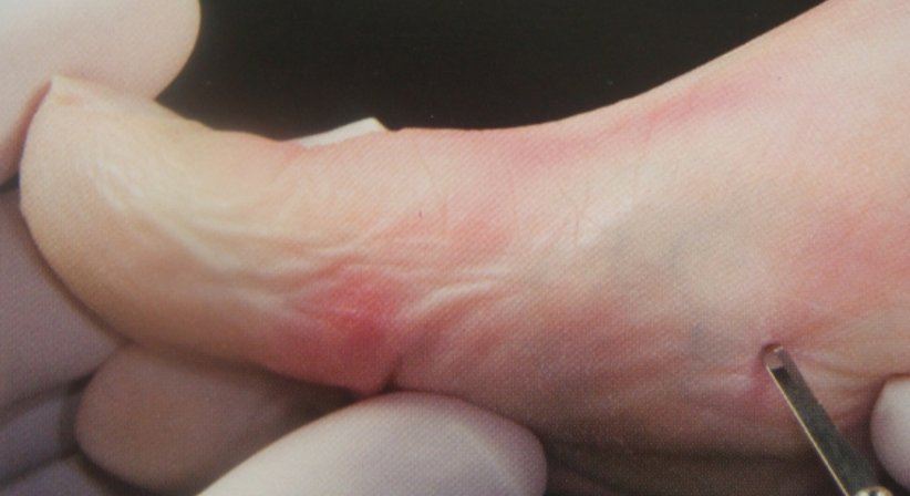 Minimal-invasive Fußchirurgie / Hallux valgus - Dr. Hermann Leidolf - Unfallchirurg Innsbruck 6020