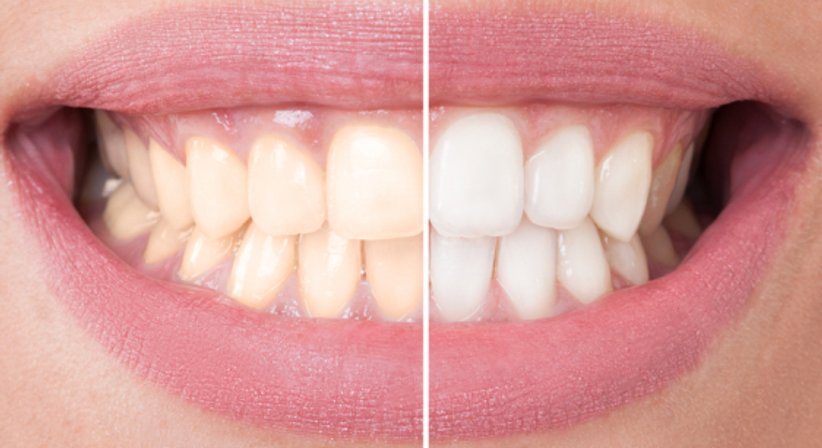 Bleaching - Dr.med.dent. Ulrich Guserl - Zahnarzt Linz 4040