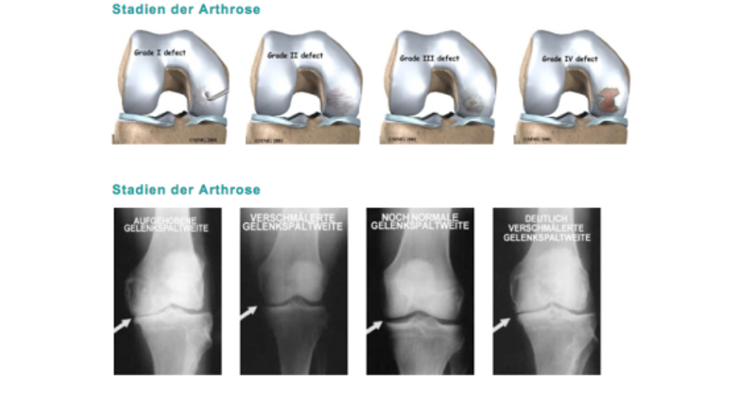 Arthrose - Dr. Hermann Leidolf - Unfallchirurg Wien 1010